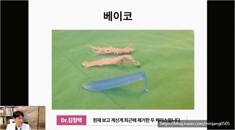 하이코 베이코 시술 실제거하는 방법 사진 10