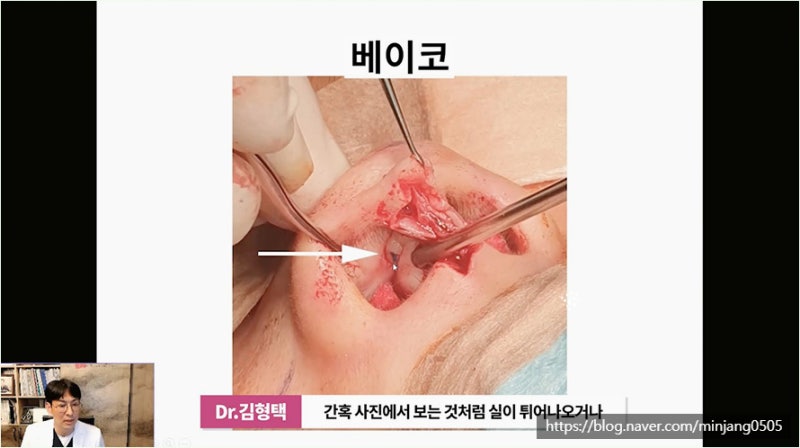 하이코 베이코 시술 실제거하는 방법 사진 5