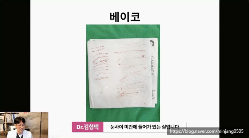 하이코 베이코 시술 실제거하는 방법 사진 8