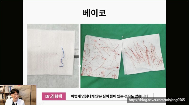 하이코 베이코 시술 실제거하는 방법 사진 7