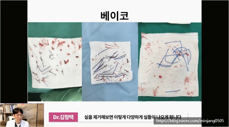하이코 베이코 시술 실제거하는 방법 사진 6