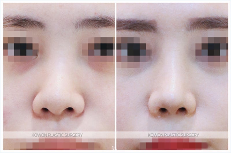 휜코성형 후기 비포 애프터 (비중격연장술) 사진 5