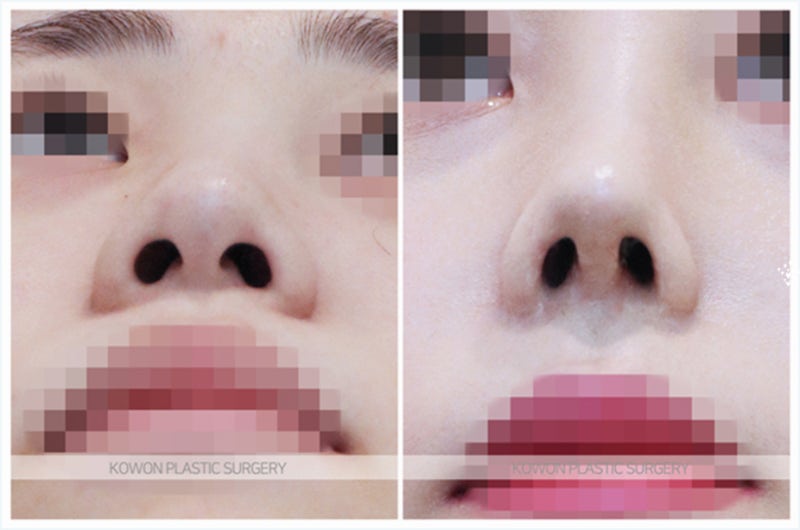 휜코성형 후기 비포 애프터 (비중격연장술) 사진 6