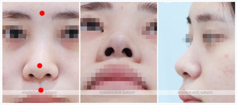 휜코성형 후기 비포 애프터 (비중격연장술)
