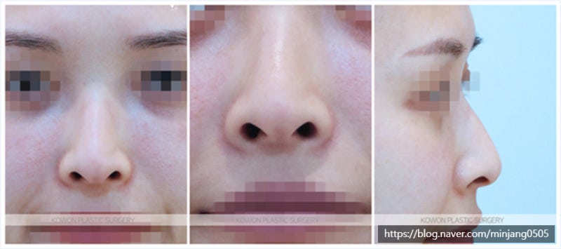 코끝높이기 전후 비교 사례 (여자매부리코) 사진 2