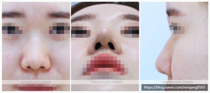 비중격만곡증수술후기 전후 사례 (쁘띠코)