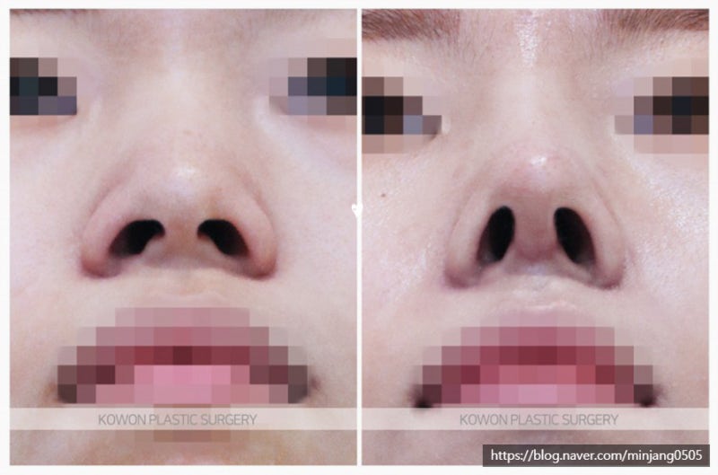 복코수술 비포 애프터 비교 (콧등절골)