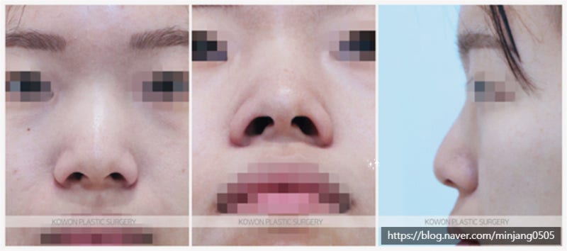 복코수술 비포 애프터 비교 (콧등절골) 사진 2
