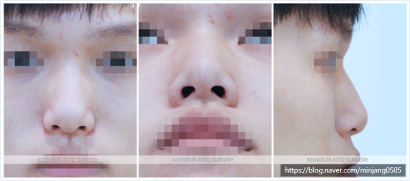 뭉툭한코 수술 전후 비교 (콧날개올리기) 사진 2