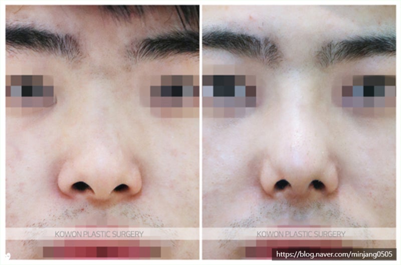 코교정 수술 후기 사례 (콧구멍작아지는법) 사진 5