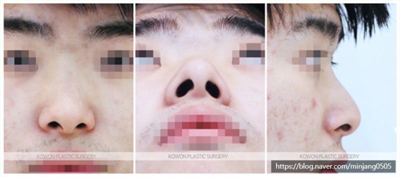 코교정 수술 후기 사례 (콧구멍작아지는법) 사진 2