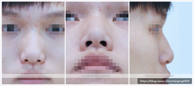 뭉툭한코 남자코끝성형 통해 개선한 사례 사진 2