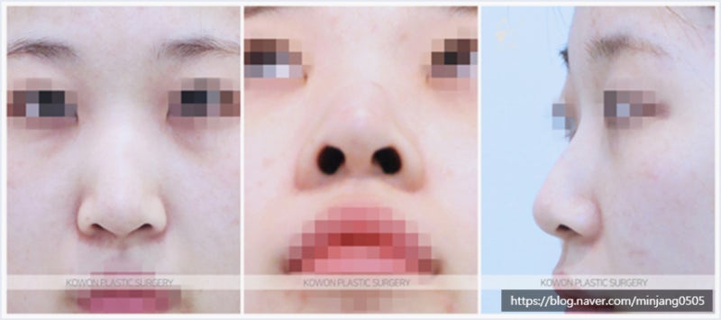 코켈로이드 여자긴코성형 코수술 잘하는 곳 사진 2