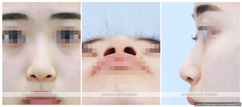 코끝높이기 위해 쉐이딩을 해도 감춰지지 않는 납작코 사진 2