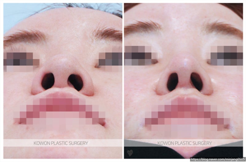 자가진피코성형 양악수술후코수술 전후 후기 사진 6