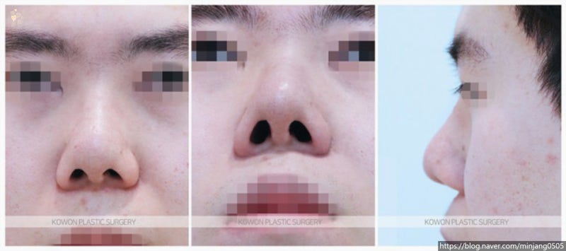 남자복코수술 교정으로 콧대높이기 사진 2