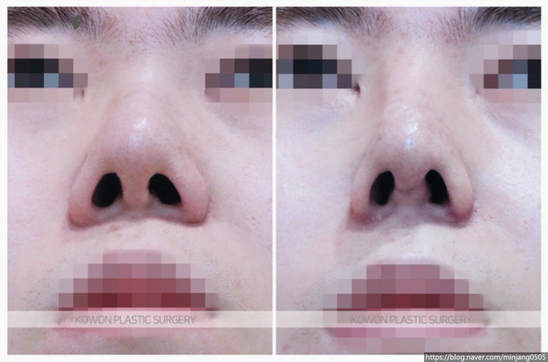 남자복코수술 교정으로 콧대높이기 사진 7