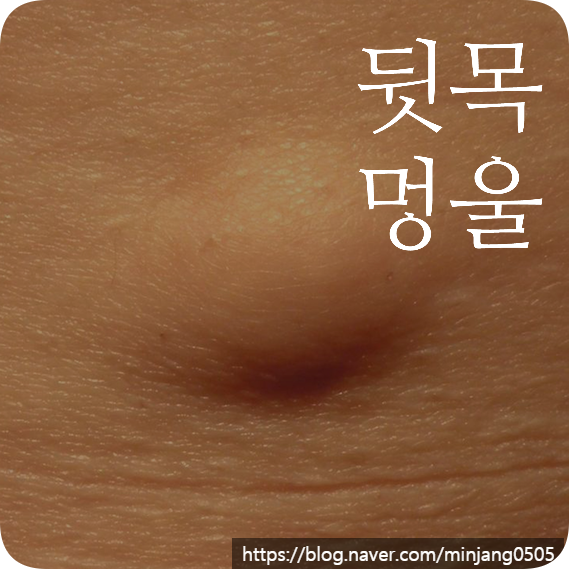뒷목 멍울 원인 자연치유 악성종양 차이