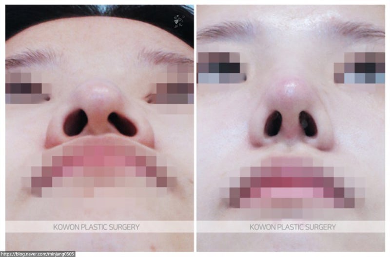 흰코교정 여자매부리코 수술 성형 전후 비교 사진 7
