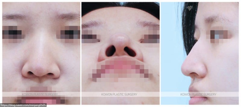 흰코교정 여자매부리코 수술 성형 전후 비교 사진 2