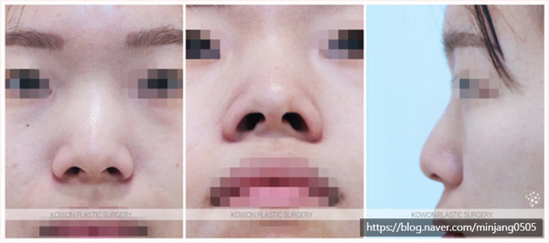 낮은코성형 콧대절골 이용한 수술후기 사진 2