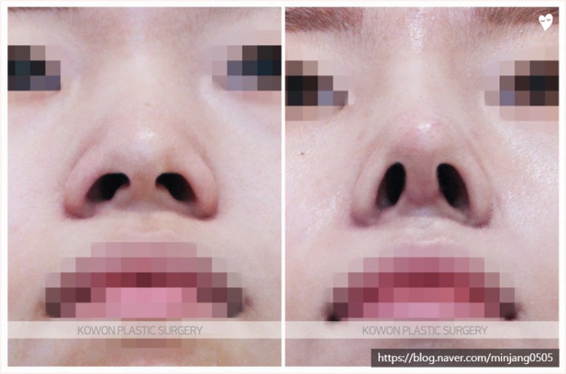 낮은코성형 콧대절골 이용한 수술후기