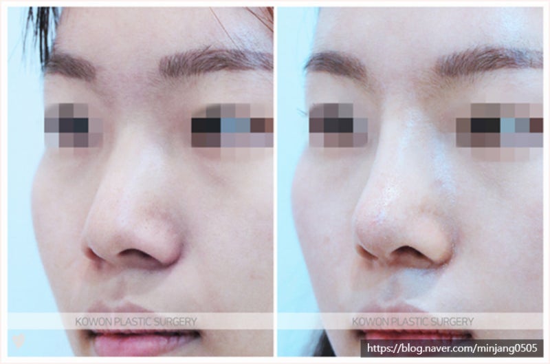 낮은코성형 콧대절골 이용한 수술후기 사진 5