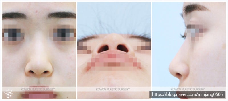 긴코길이 개선 수술 후기 사례 (콧볼 작아지는법) 사진 2