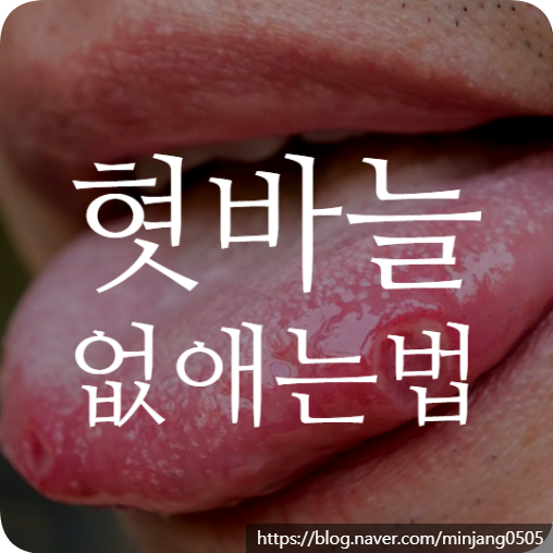 혓바늘 없애는법 원인과 예방법