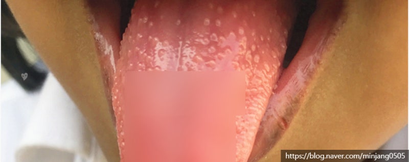 혓바늘 없애는법 원인과 예방법 사진 3
