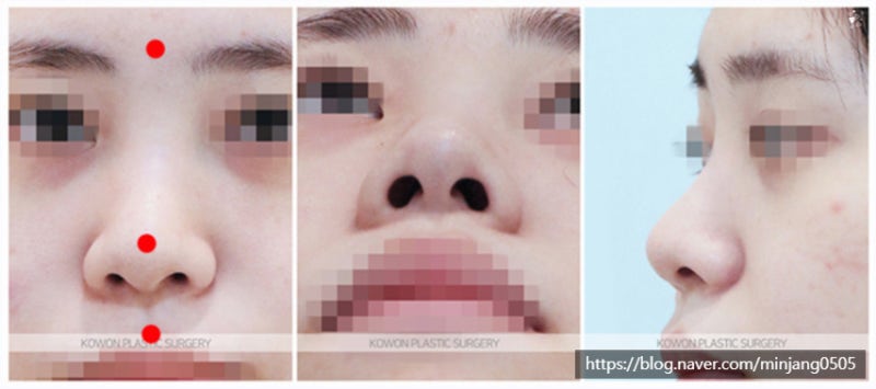 비중격만곡증수술 잘하는 압구정역코성형 사진 2