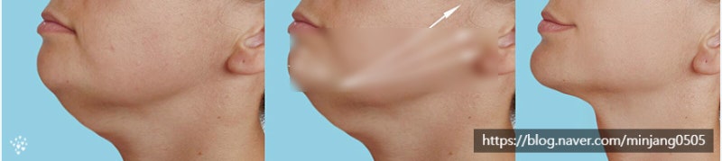턱밑 몽우리 생기는 원인 사진 3