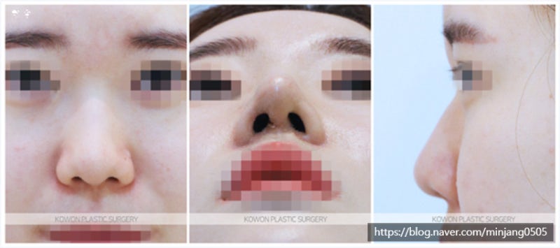 강남코재수술 후기 및 하이코부작용 사진 2