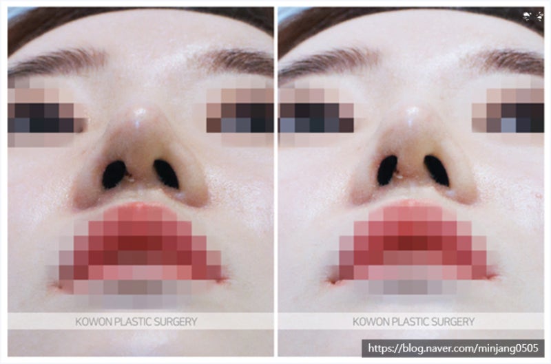 강남코재수술 후기 및 하이코부작용 사진 7