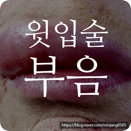 윗입술부음 원인 및 증상 혈관부종