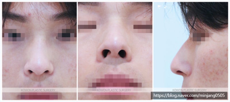 무보형물코수술 코휨 수술후기 (남자매부리코성형) 사진 2