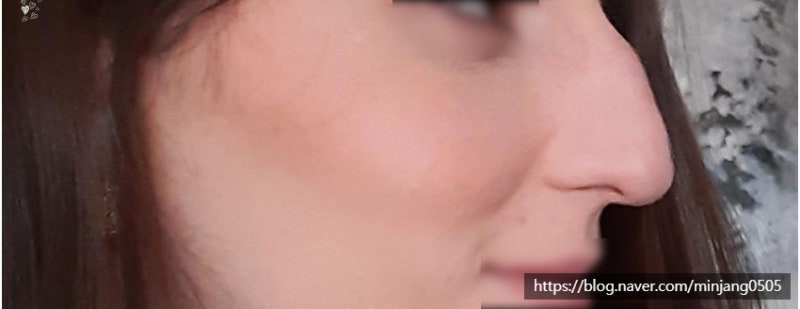 코뼈 금가면 대처방법 및 치료법 사진 7