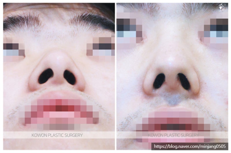 코성형비중격만곡증 코휘어짐 개선사례 사진 6