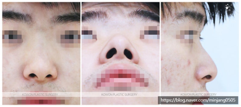 코성형비중격만곡증 코휘어짐 개선사례 사진 2