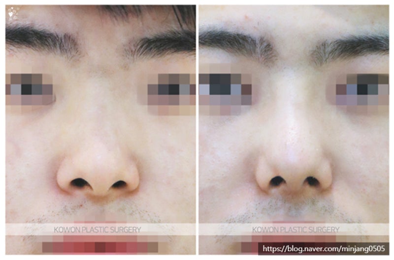코성형비중격만곡증 코휘어짐 개선사례 사진 5