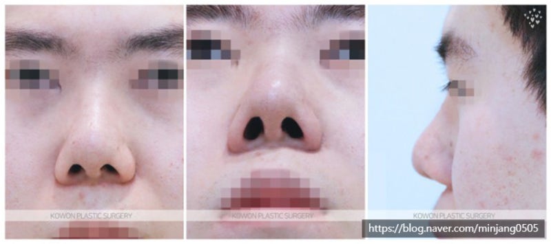 압구정코성형외과 비순각수술 잘하는곳 사진 2