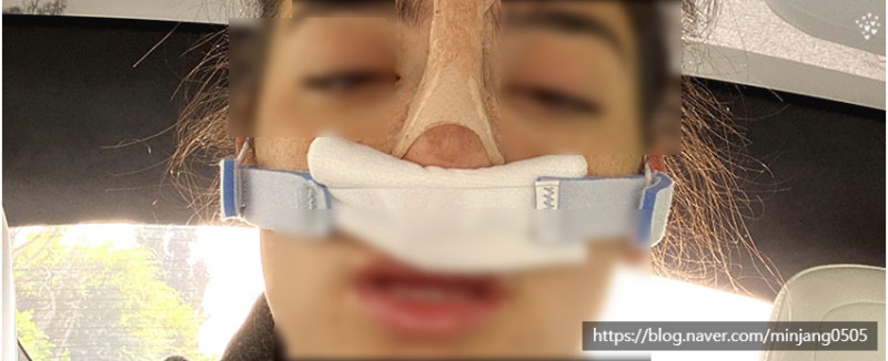 코수술후코딱지 면봉정리 사진 3
