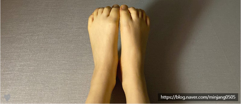 L자다리효과 및 붓기 개선 사진 11
