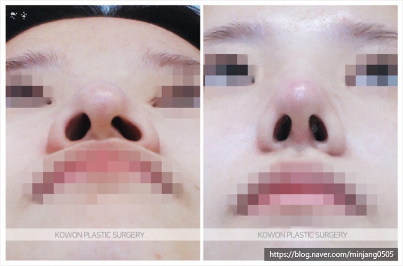 비주내리기 비대칭 매부리코수술후기 사진 7