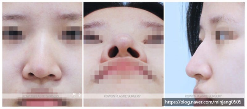 비주내리기 비대칭 매부리코수술후기 사진 2