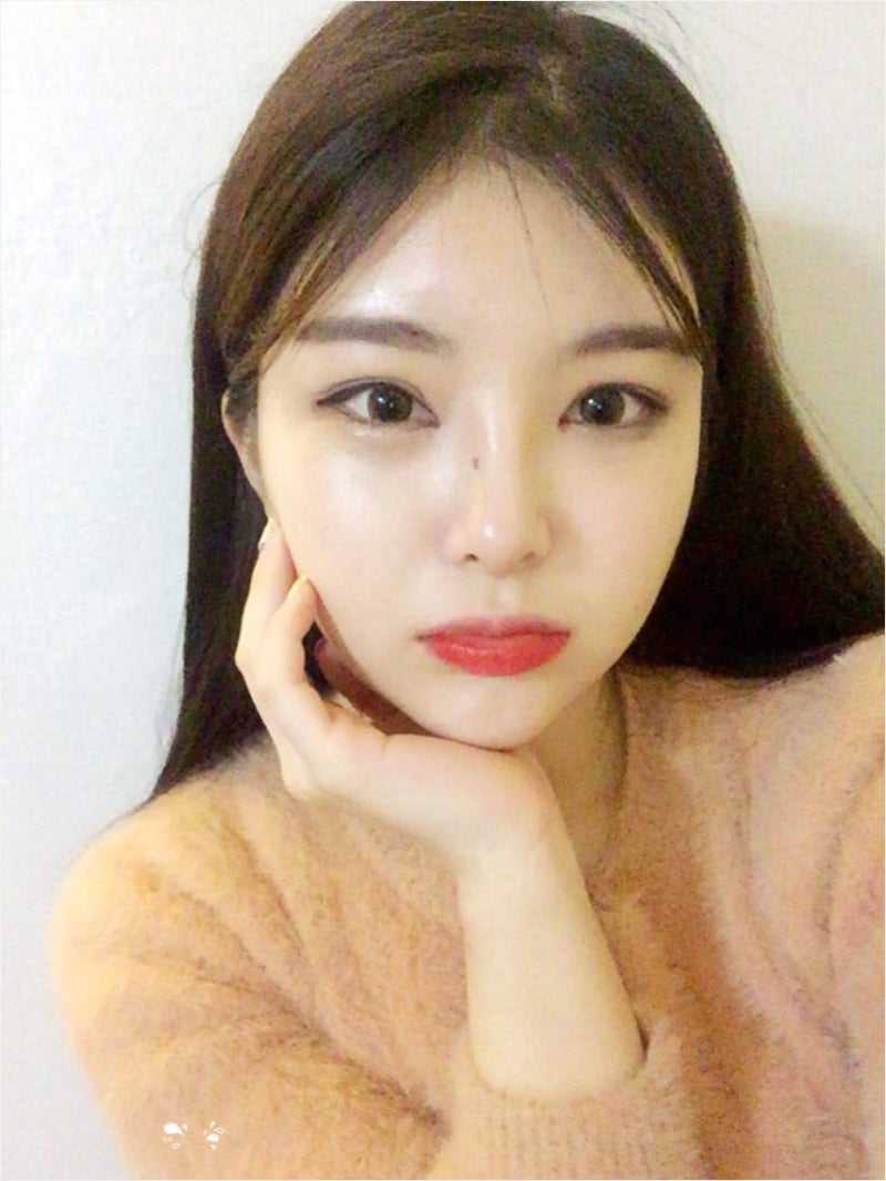 자연스러운 복코수술 후기입니다! (코원리얼후기) 사진 3