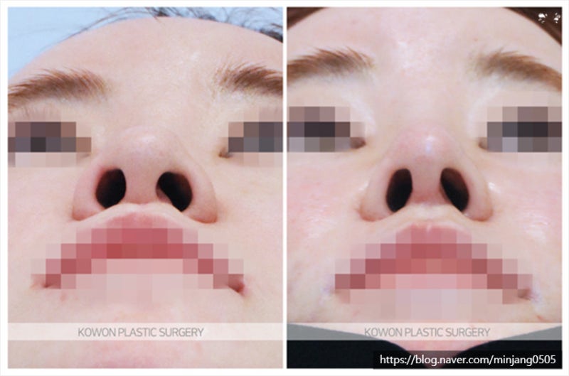 자가늑연골 코끝올리기 수술 (양악수술후코성형)