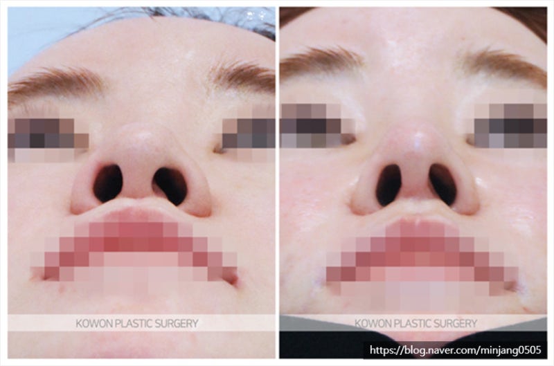 자가늑연골 코끝올리기 수술 (양악수술후코성형) 사진 6