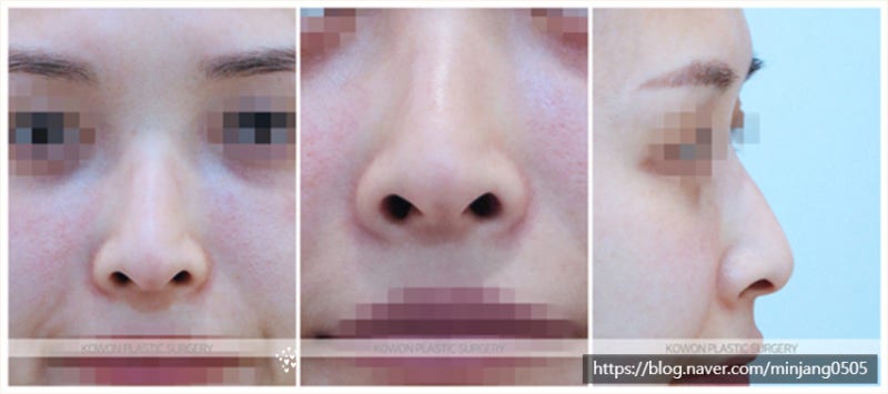 비공내리기 수술 및 코휘어짐 개선 사례 사진 3