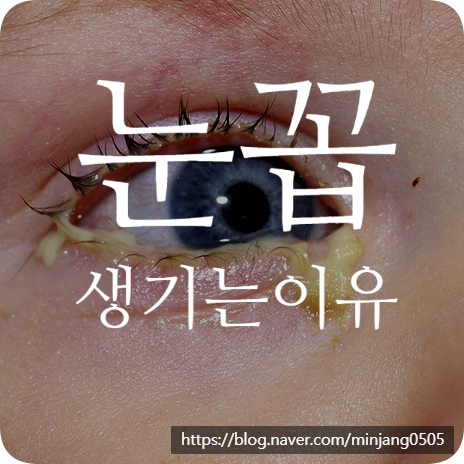 눈꼽생기는이유 및 관리법